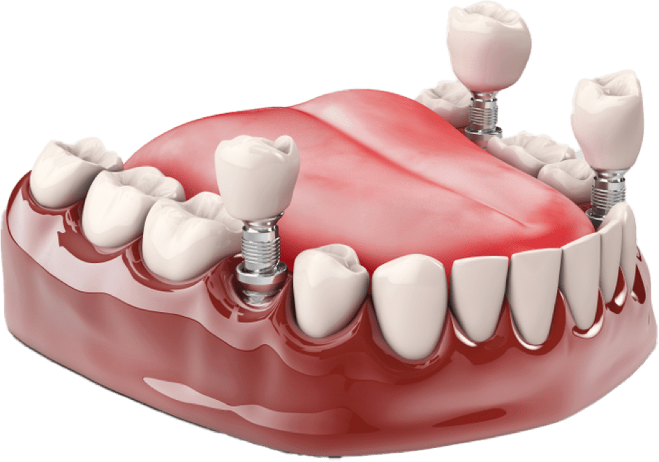 More Congleton All-on-4 Dental Implants Full-Arch Teeth Replacement Consultations Made Available at Crown Bank Dental